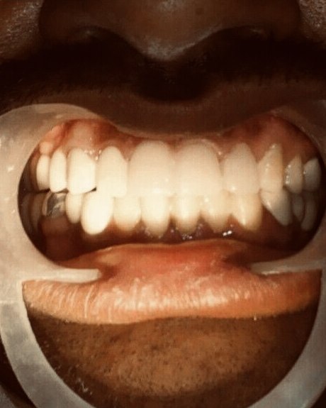 Full-mouth crown rehabilitation &mdash; after treatment