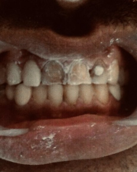 Full-mouth crown rehabilitation &mdash; before treatment