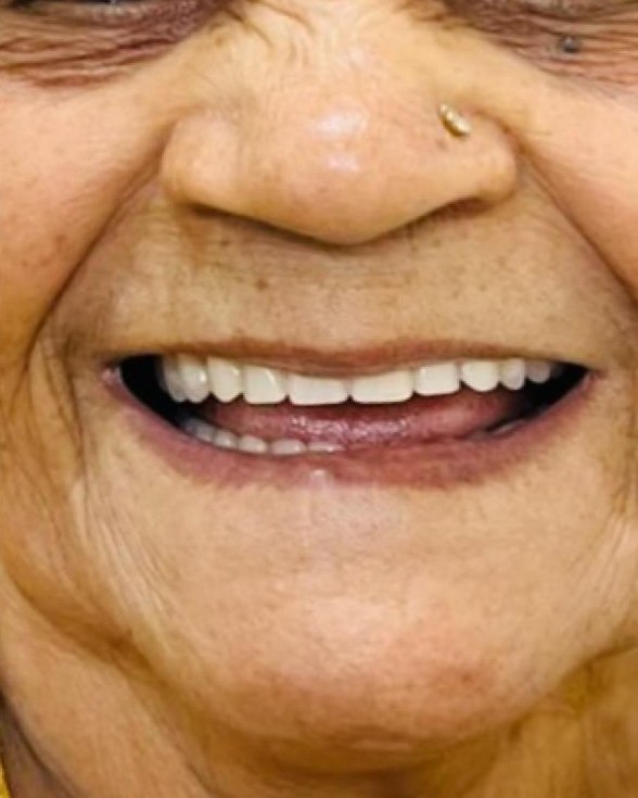 Full-Mouth Rehabilitation — after treatment