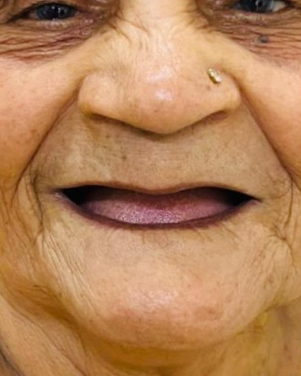 Full-Mouth Rehabilitation — before treatment