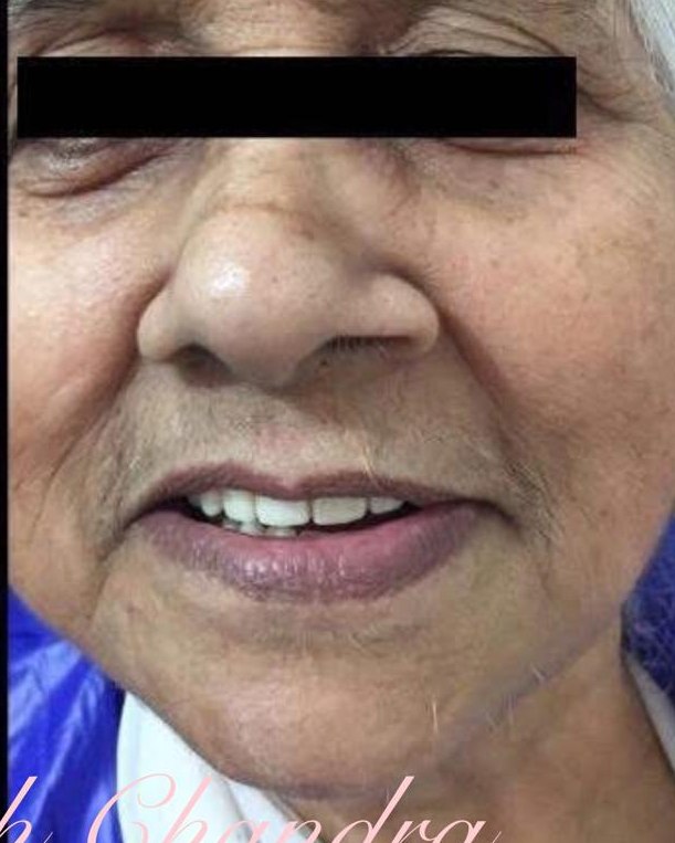 Full-Arch Restoration — after treatment