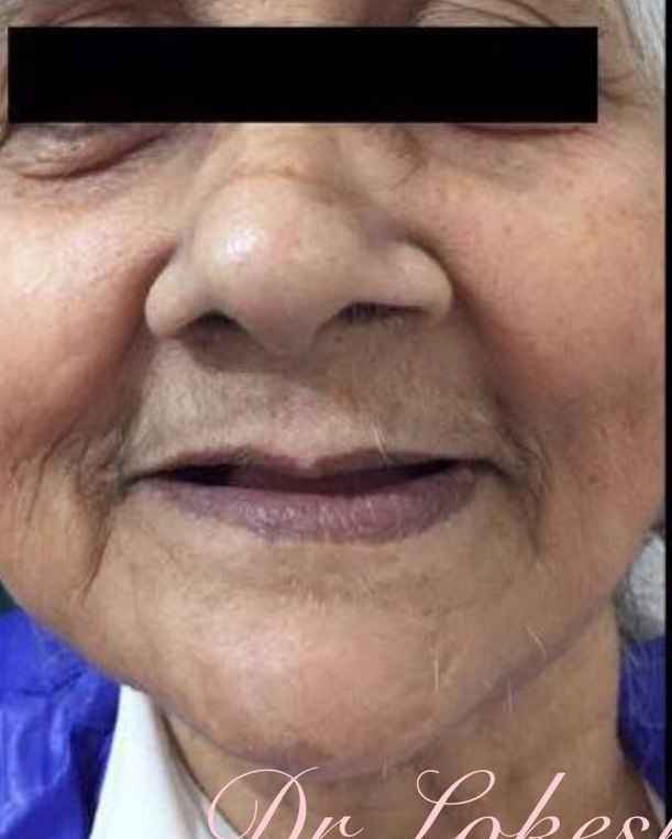 Full-Arch Restoration — before treatment