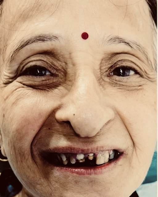 Full-mouth rehabilitation &mdash; before treatment
