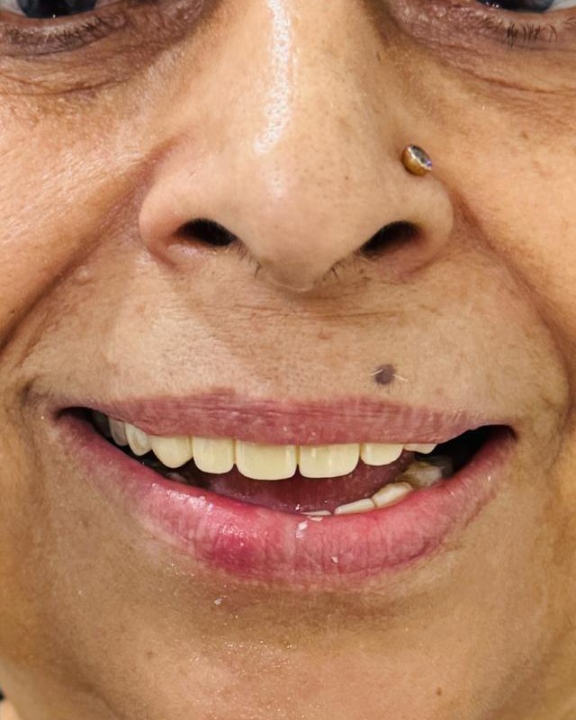 Full-Mouth Rehabilitation — after treatment