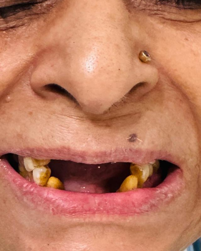 Full-Mouth Rehabilitation — before treatment
