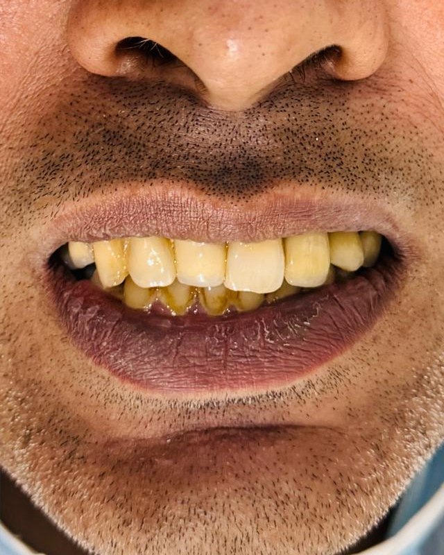 Full-Mouth Rehabilitation — after treatment