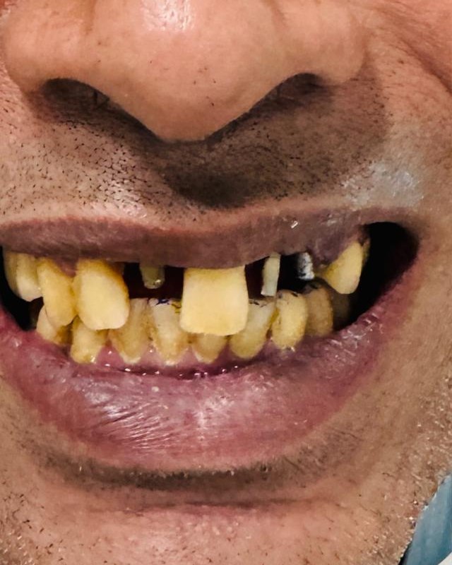 Full-Mouth Rehabilitation — before treatment