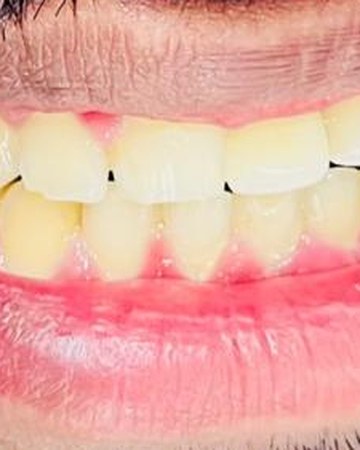 Single tooth implant — after