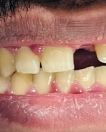 Single tooth implant — before