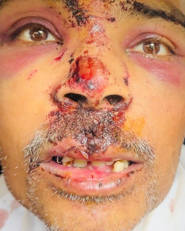 Post-Traumatic Reconstruction — before treatment
